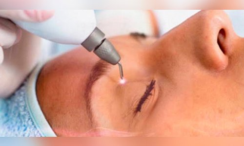 Saiba os benefícios do jato de plasma, procedimento facial sem cortes